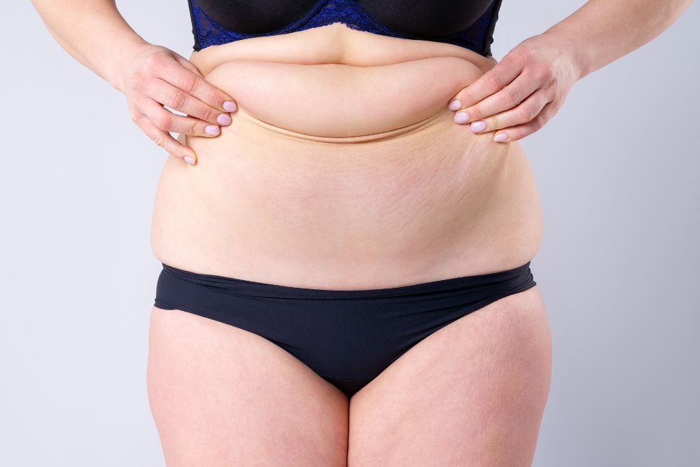 What is a Tummy Tuck Procedure