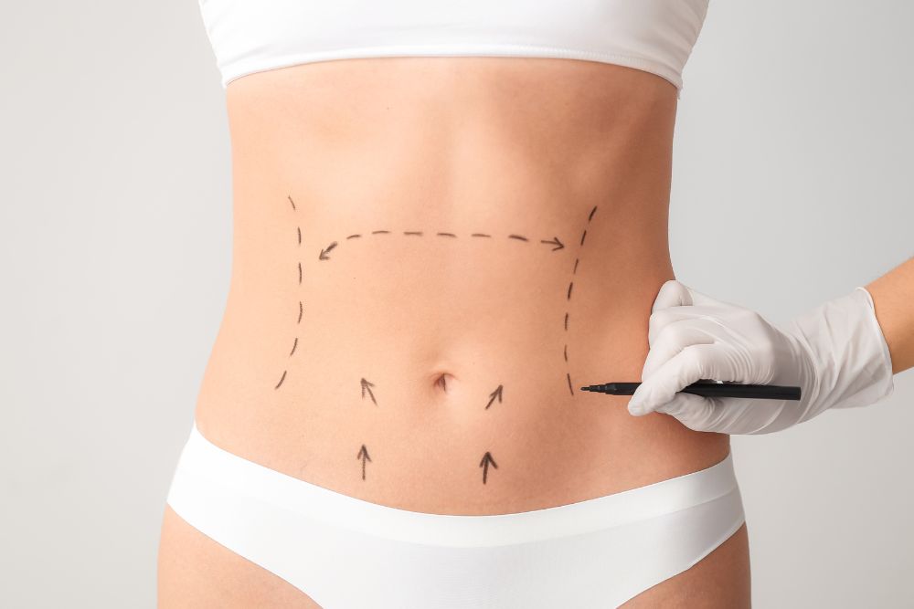 Abdominoplasty Scar Healing_ Your Essential Guide