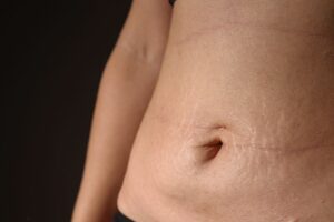 Best Ways to Remove Tummy Tuck Scar_ Treatments and Tips