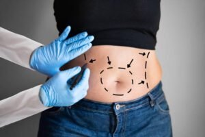 Tummy tuck