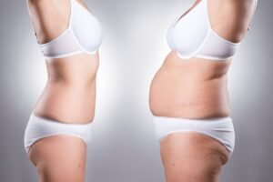 Liposuction