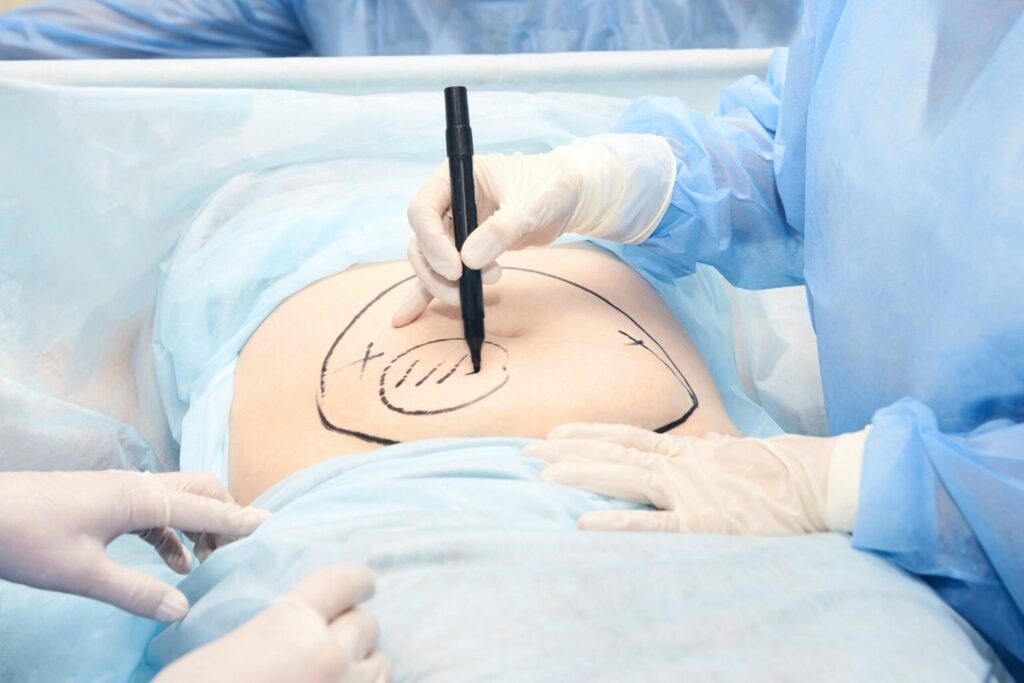 Liposuction surgeon