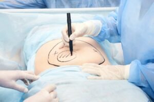 Liposuction surgeon