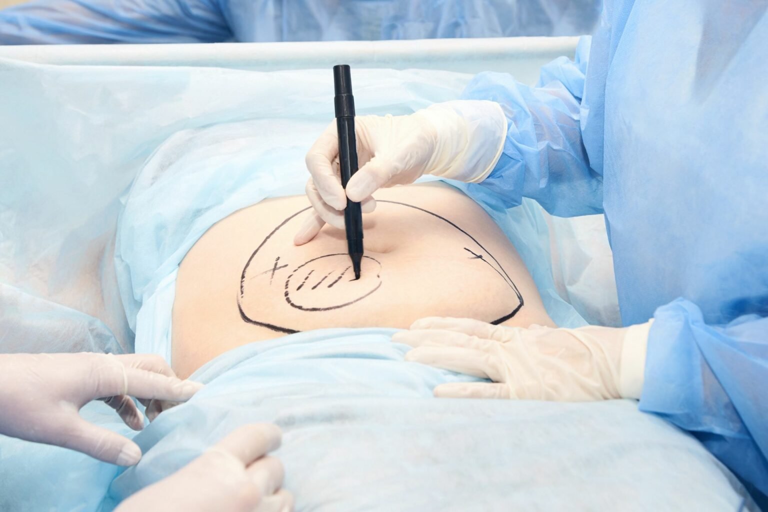 Liposuction surgeon