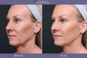 Before & After Plastic Surgery by Dr. Joseph R. Barnthouse
